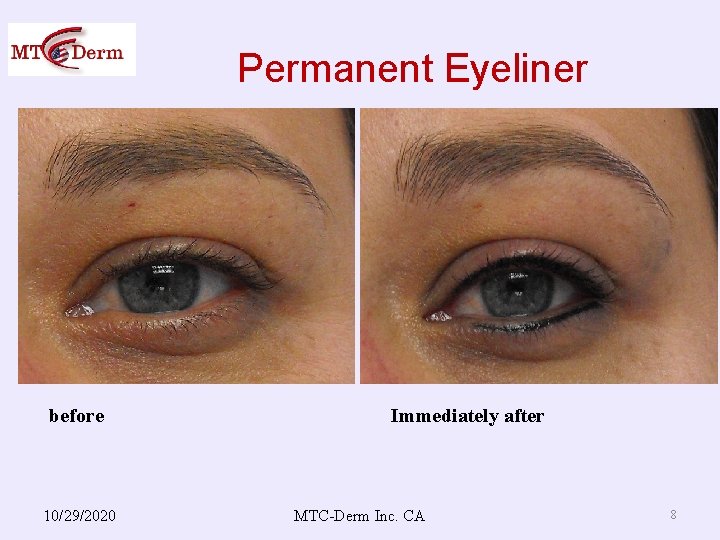 Permanent Eyeliner before 10/29/2020 Immediately after MTC-Derm Inc. CA 8 