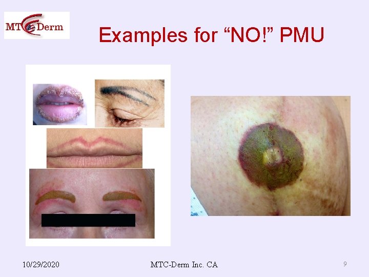 Examples for “NO!” PMU 10/29/2020 MTC-Derm Inc. CA 9 