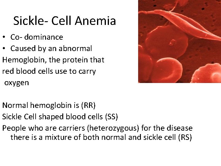 Sickle- Cell Anemia • Co- dominance • Caused by an abnormal Hemoglobin, the protein