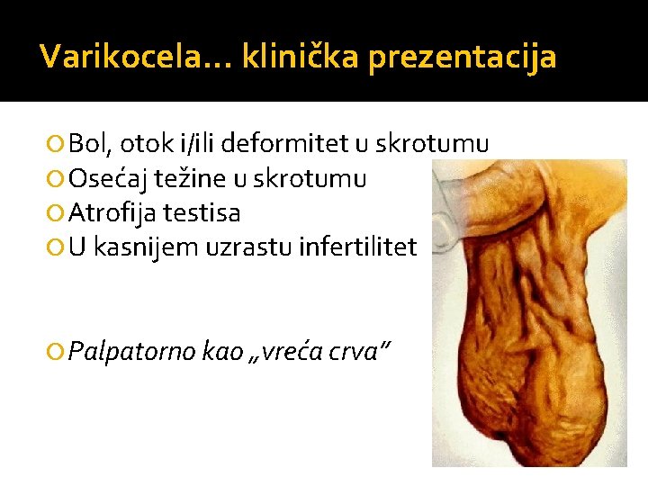 Varikocela. . . klinička prezentacija Bol, otok i/ili deformitet u skrotumu Osećaj težine u