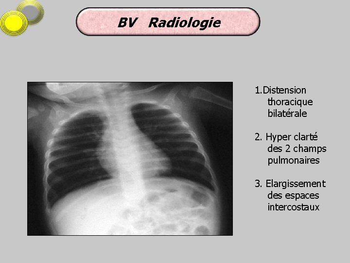 BV Radiologie 1. Distension thoracique bilatérale 2. Hyper clarté des 2 champs pulmonaires 3.