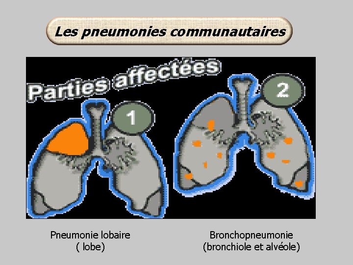 Les pneumonies communautaires Pneumonie lobaire ( lobe) Bronchopneumonie (bronchiole et alvéole) 