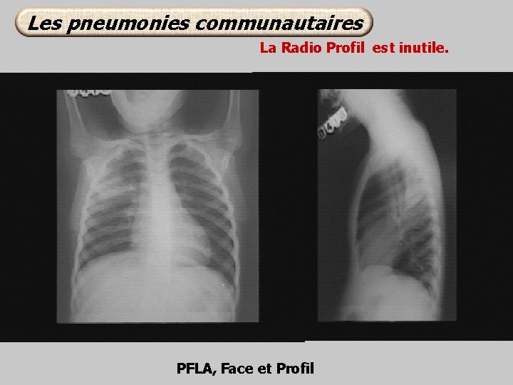 Les pneumonies communautaires La Radio Profil est inutile. PFLA, Face et Profil 