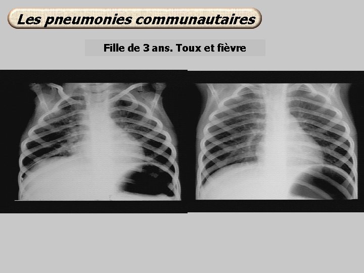 Les pneumonies communautaires Fille de 3 ans. Toux et fièvre 