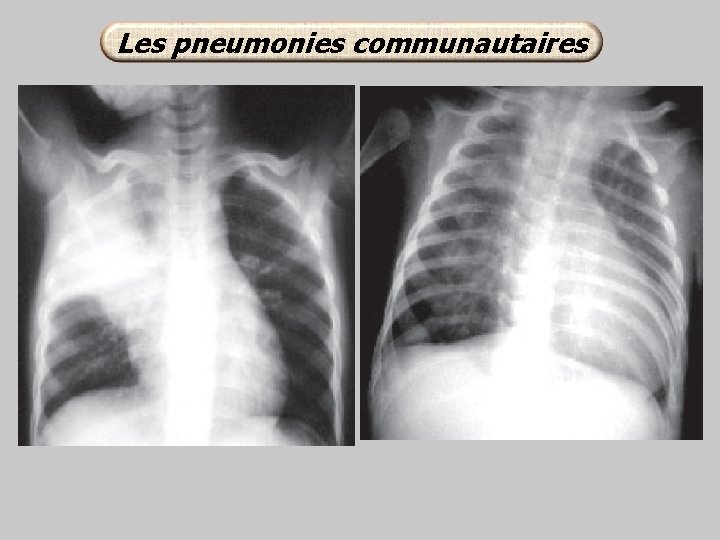 Les pneumonies communautaires 