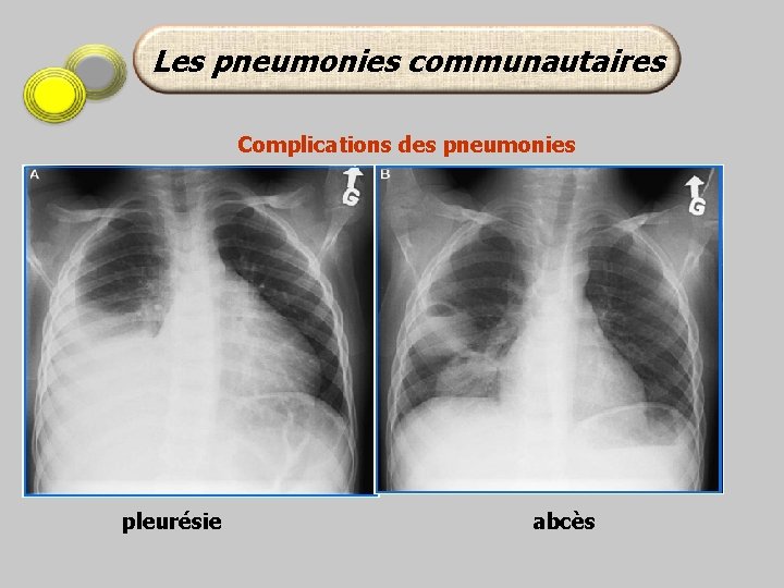 Les pneumonies communautaires Complications des pneumonies pleurésie abcès 