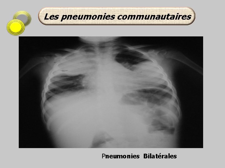 Les pneumonies communautaires Pneumonies Bilatérales 