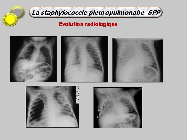 La staphylococcie pleuropulmonaire SPP Evolution radiologique 
