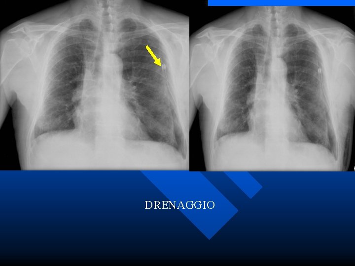 DRENAGGIO 