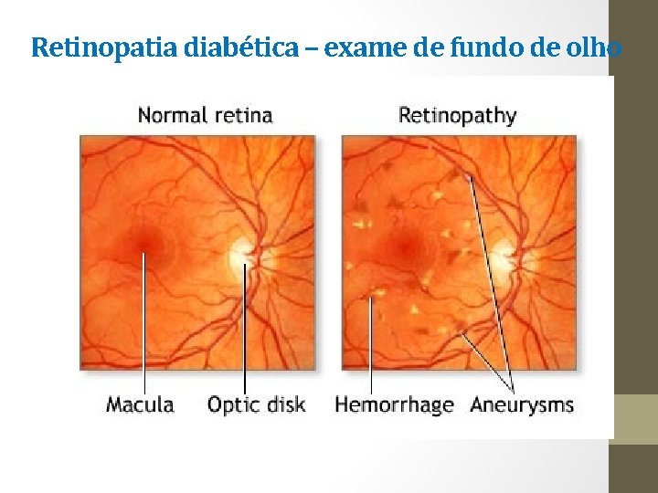 Retinopatia diabética – exame de fundo de olho 