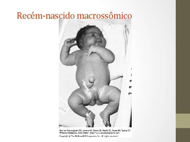 Recém-nascido macrossômico 