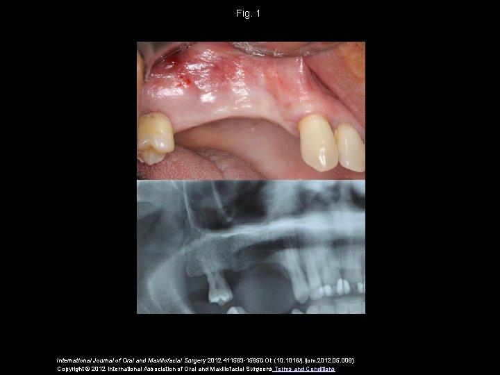 Fig. 1 International Journal of Oral and Maxillofacial Surgery 2012 411563 -1565 DOI: (10.