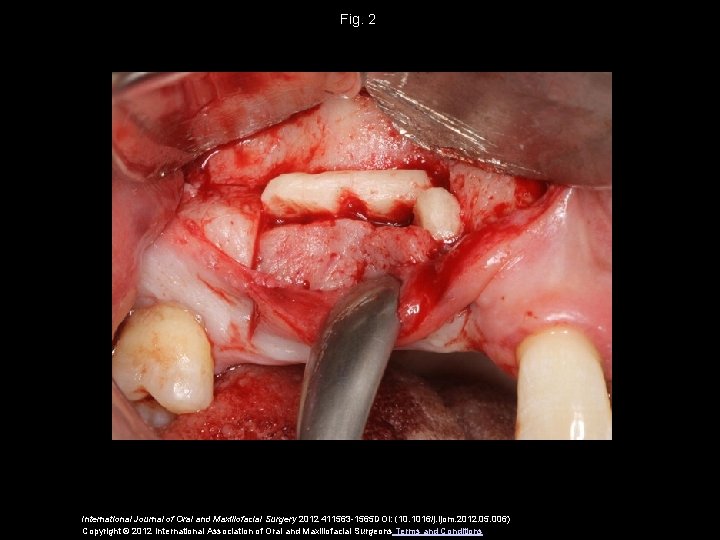 Fig. 2 International Journal of Oral and Maxillofacial Surgery 2012 411563 -1565 DOI: (10.