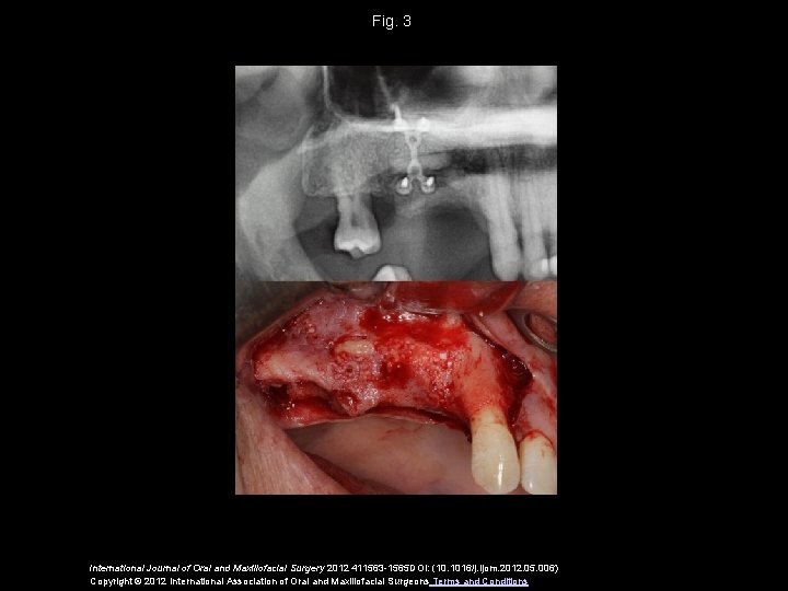 Fig. 3 International Journal of Oral and Maxillofacial Surgery 2012 411563 -1565 DOI: (10.