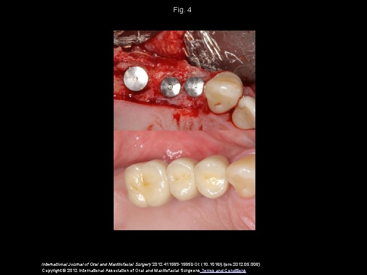 Fig. 4 International Journal of Oral and Maxillofacial Surgery 2012 411563 -1565 DOI: (10.