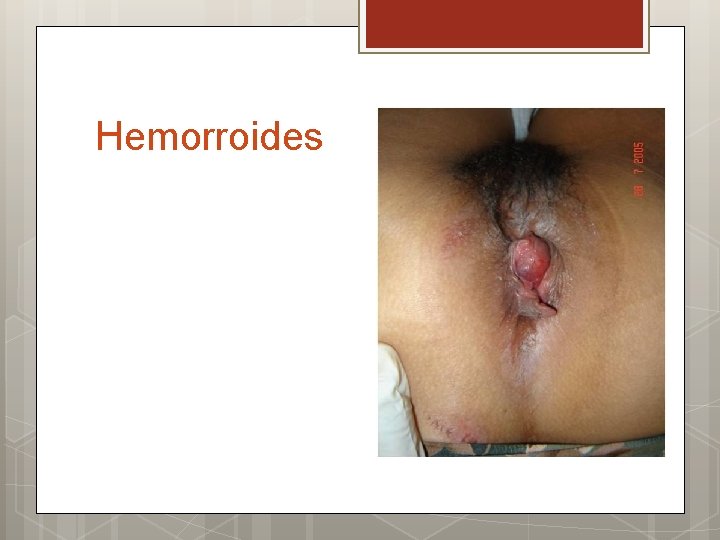 Hemorroides 