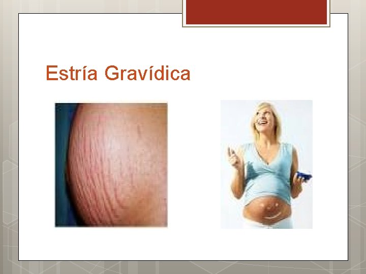 Estría Gravídica 