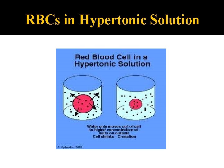 RBCs in Hypertonic Solution 