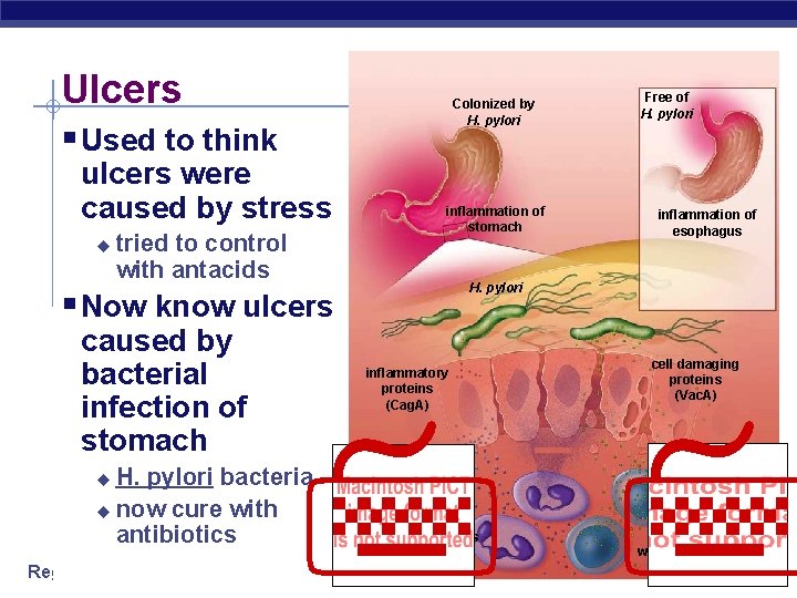 Ulcers Colonized by H. pylori § Used to think ulcers were caused by stress