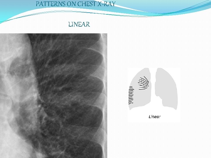 PATTERNS ON CHEST X-RAY LINEAR 