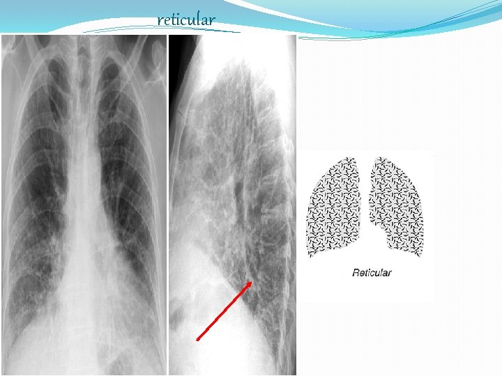 reticular 