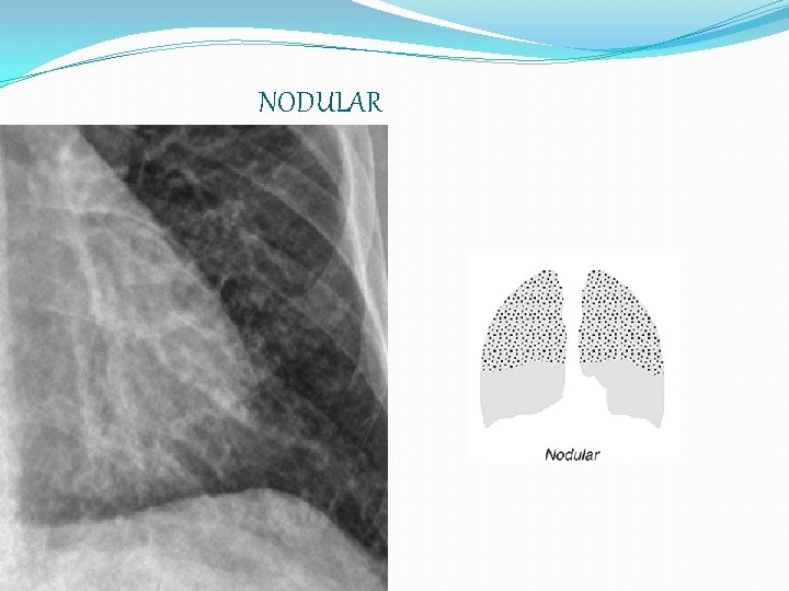 NODULAR 