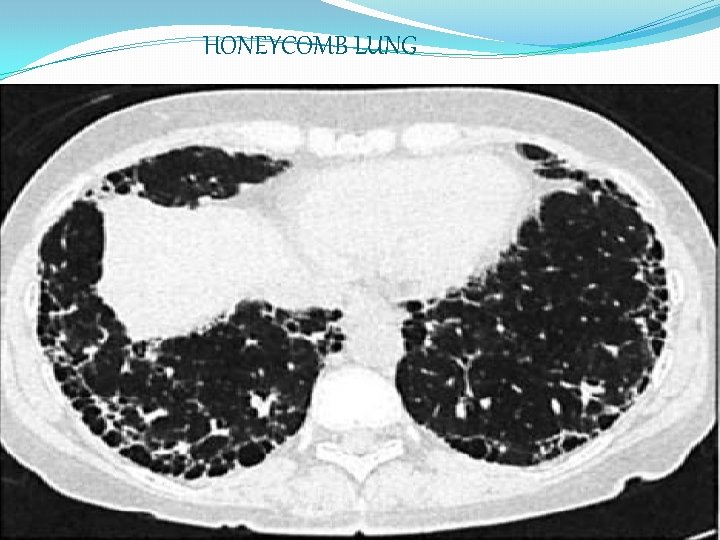 HONEYCOMB LUNG 