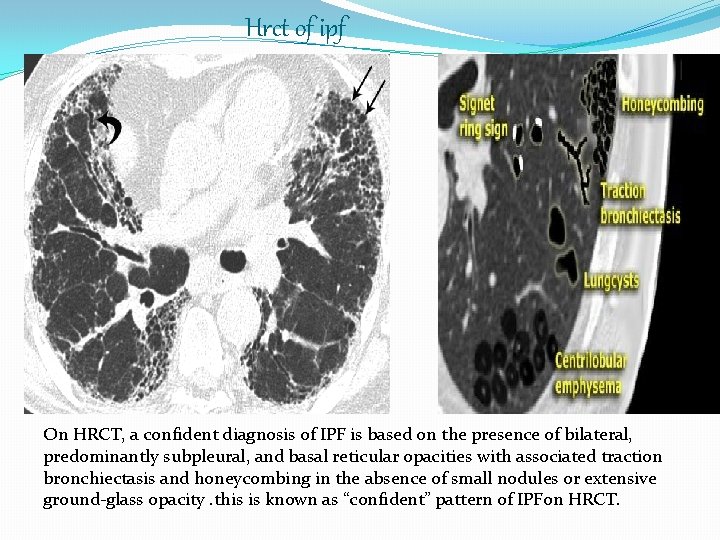Hrct of ipf On HRCT, a confident diagnosis of IPF is based on the