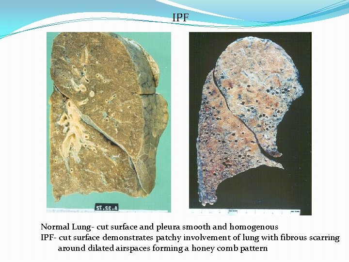 IPF Normal Lung- cut surface and pleura smooth and homogenous IPF- cut surface demonstrates