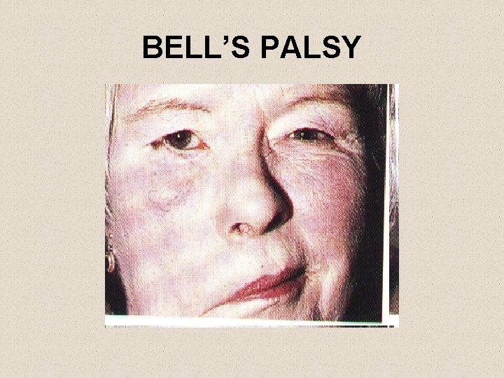 BELL’S PALSY 