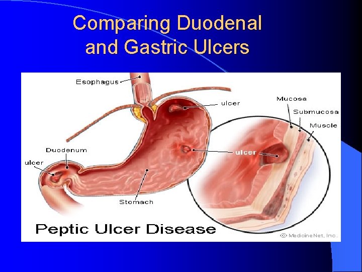 Comparing Duodenal and Gastric Ulcers 