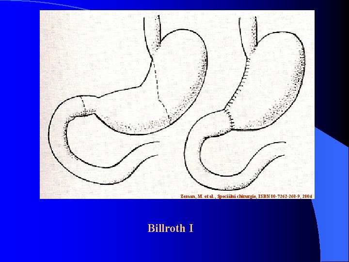 Zeman, M. et al. , Speciální chirurgie, ISBN 80 -7262 -260 -9, 2004 Billroth Zeman, M. et al. , Speciální chirurgie, ISBN 80 -7262 -260 -9, 2004 Billroth