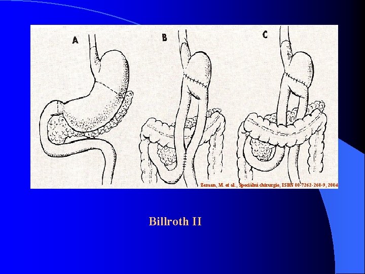 Zeman, M. et al. , Speciální chirurgie, ISBN 80 -7262 -260 -9, 2004 Billroth