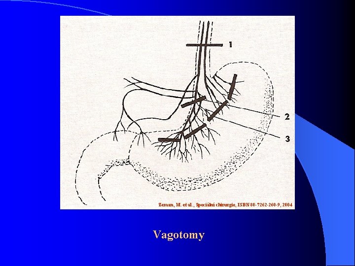 Zeman, M. et al. , Speciální chirurgie, ISBN 80 -7262 -260 -9, 2004 Vagotomy