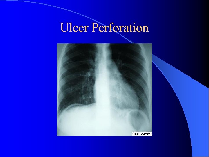 Ulcer Perforation 