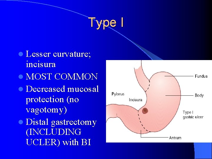 Type I l Lesser curvature; incisura l MOST COMMON l Decreased mucosal protection (no