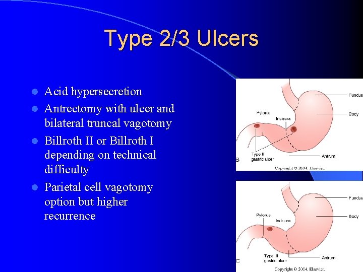 Type 2/3 Ulcers Acid hypersecretion l Antrectomy with ulcer and bilateral truncal vagotomy l Type 2/3 Ulcers Acid hypersecretion l Antrectomy with ulcer and bilateral truncal vagotomy l