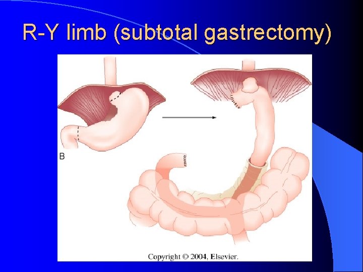 R-Y limb (subtotal gastrectomy) 