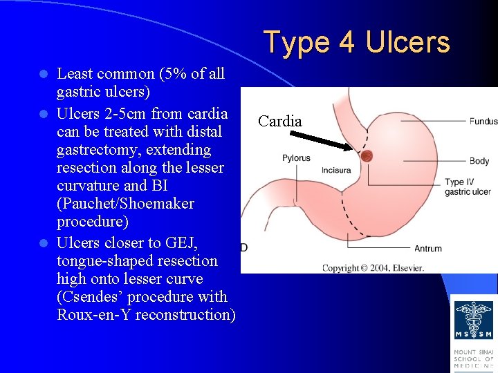 Type 4 Ulcers Least common (5% of all gastric ulcers) l Ulcers 2 -5 Type 4 Ulcers Least common (5% of all gastric ulcers) l Ulcers 2 -5