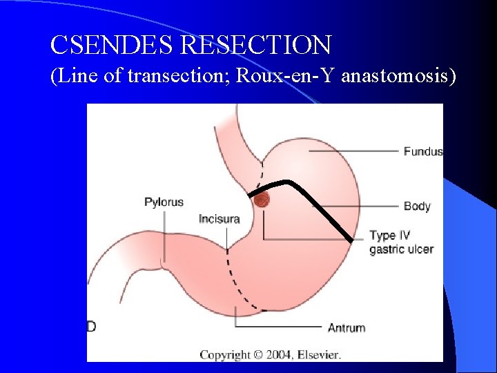 CSENDES RESECTION (Line of transection; Roux-en-Y anastomosis) 