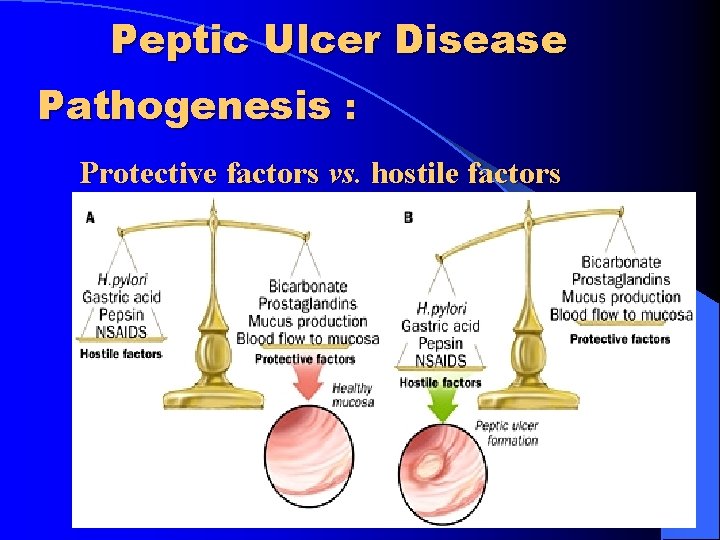 Peptic Ulcer Disease Pathogenesis : Protective factors vs. hostile factors 