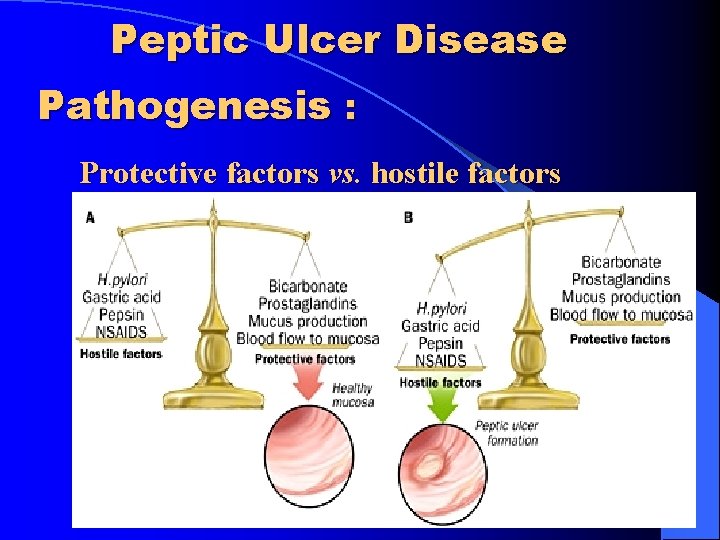 Peptic Ulcer Disease Pathogenesis : Protective factors vs. hostile factors Peptic Ulcer Disease Pathogenesis : Protective factors vs. hostile factors