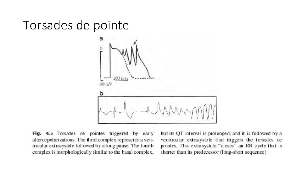 Torsades de pointe 