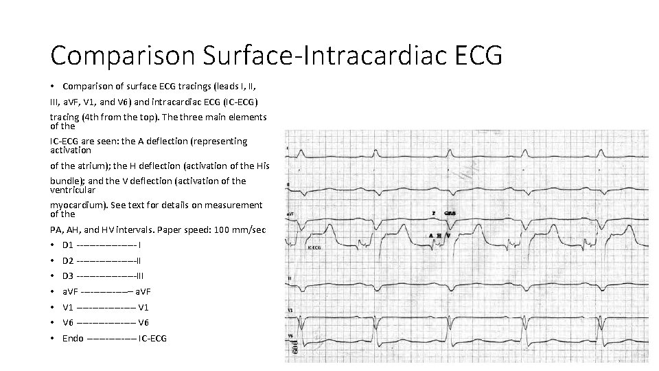 Comparison Surface-Intracardiac ECG • Comparison of surface ECG tracings (leads I, III, a. VF,