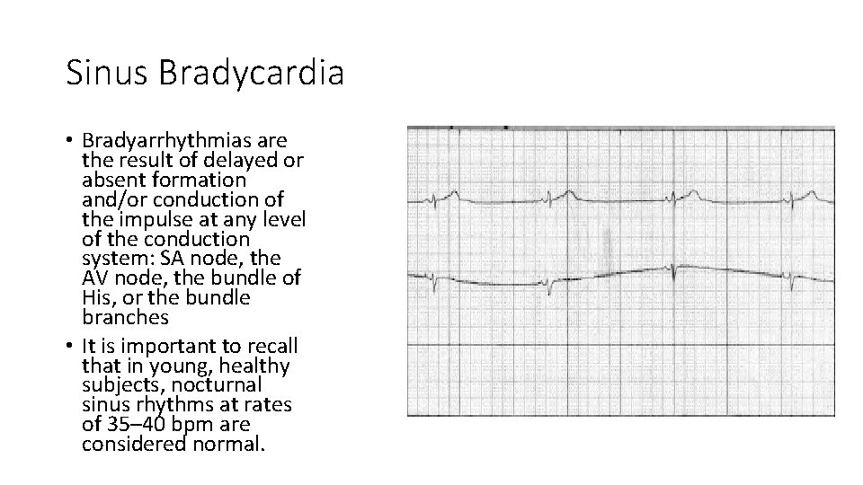 Sinus Bradycardia • Bradyarrhythmias are the result of delayed or absent formation and/or conduction