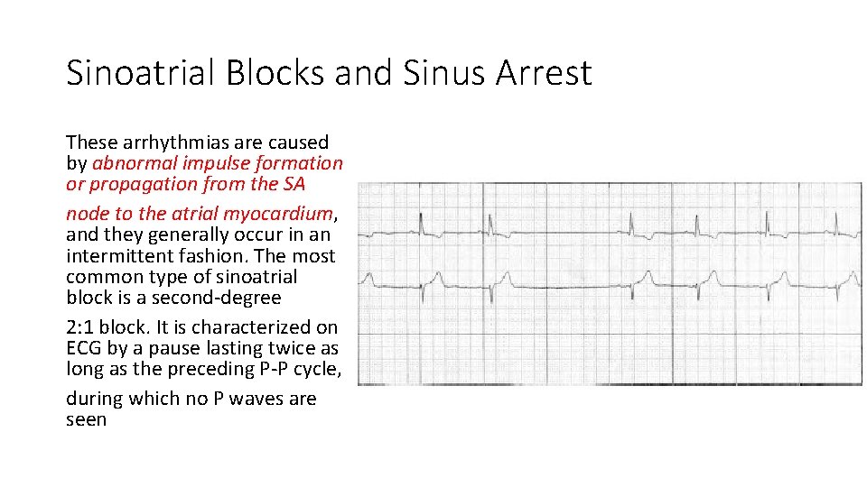 Sinoatrial Blocks and Sinus Arrest These arrhythmias are caused by abnormal impulse formation or