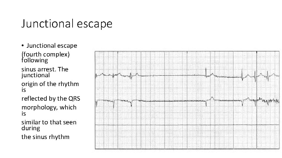 Junctional escape • Junctional escape (fourth complex) following sinus arrest. The junctional origin of
