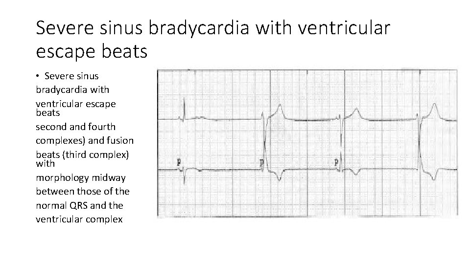 Severe sinus bradycardia with ventricular escape beats • Severe sinus bradycardia with ventricular escape