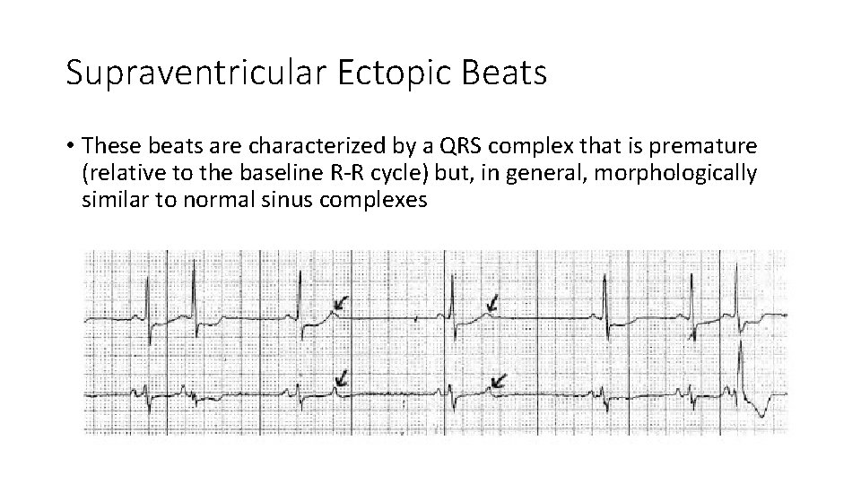 Supraventricular Ectopic Beats • These beats are characterized by a QRS complex that is