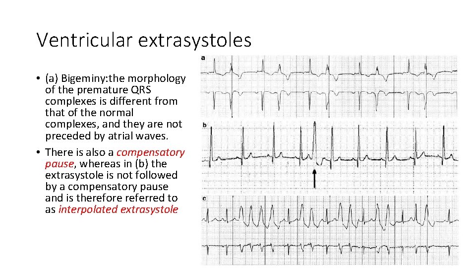 Ventricular extrasystoles • (a) Bigeminy: the morphology of the premature QRS complexes is different